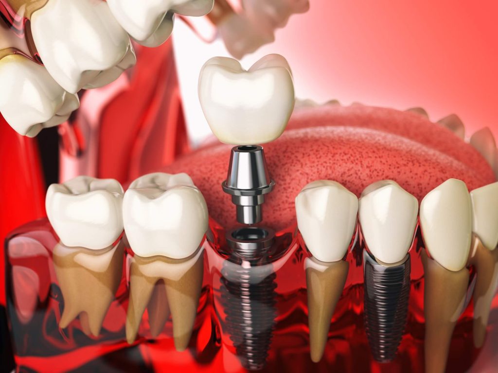İstanbul İmplant implant tedavisi