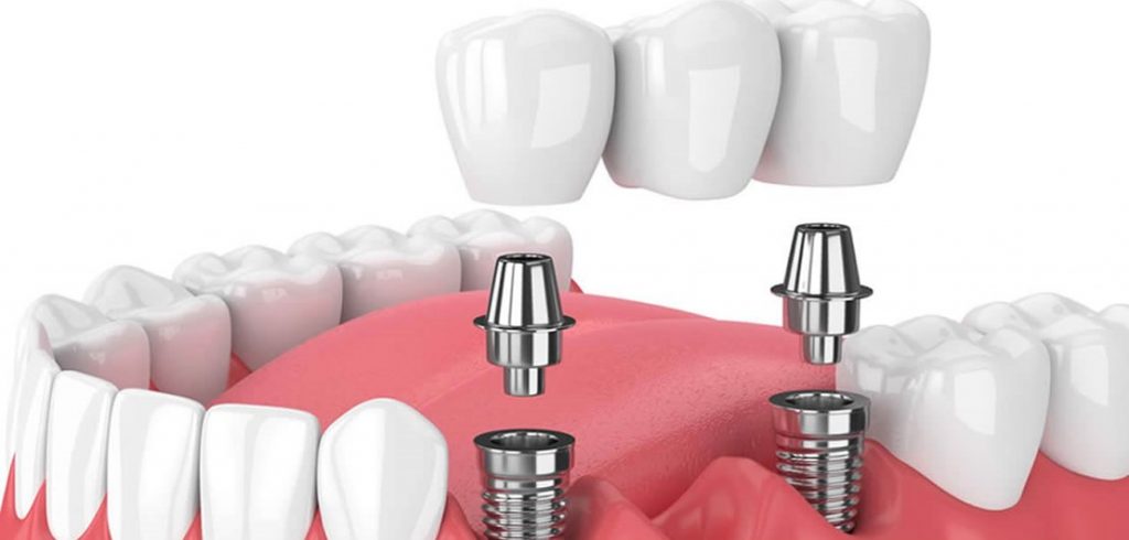 İstanbul İmplant Pendik implant tedavisi