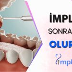 İmplant Tedavisi