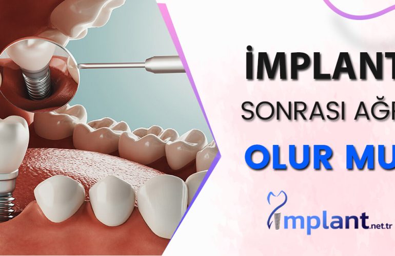 İmplant Tedavisi