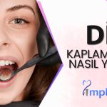 İmplant Tedavisi